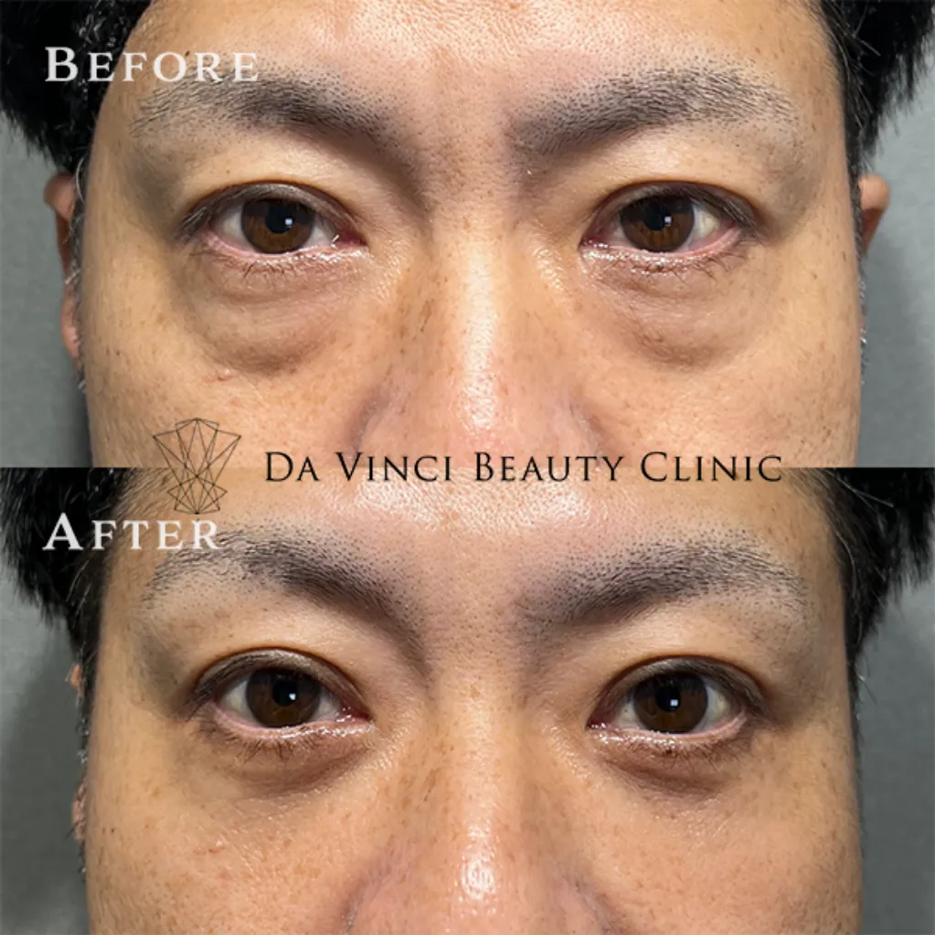 40~50代男性 目の下の切らないクマ取り術前・術後の比較症例写真