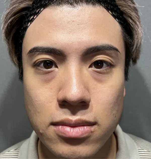 【メンズクマ取り症例】30代男性の目の下の膨らみ・たるみ取り。疲れ顔を解消した比較写真。