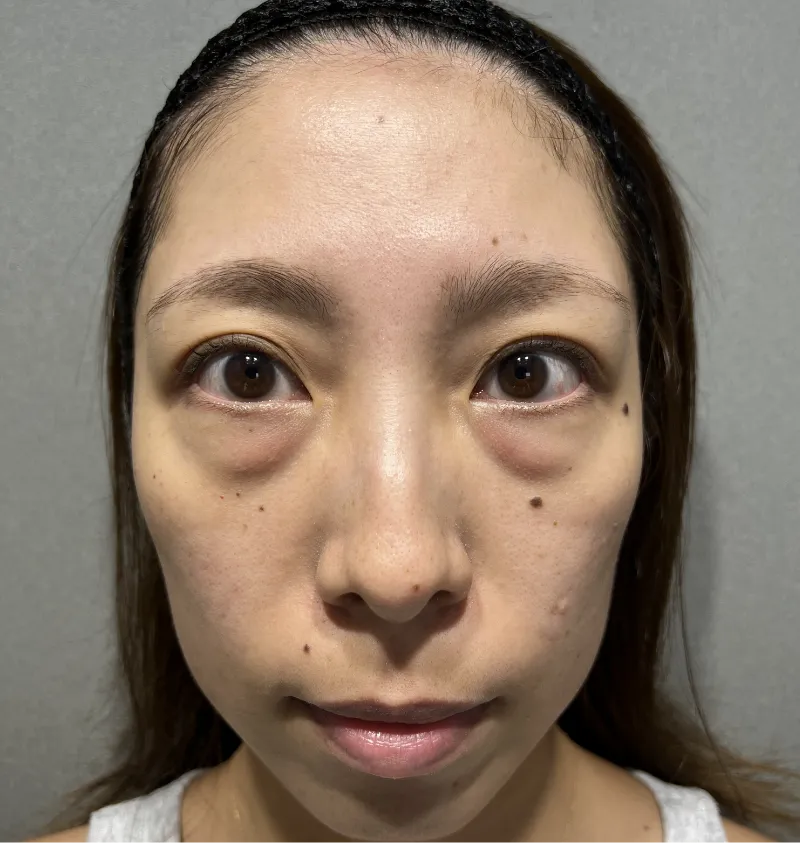 【クマ取り症例写真】30代女性のBefore/After。黒クマ・目袋の影を解消し目元を明るく改善。