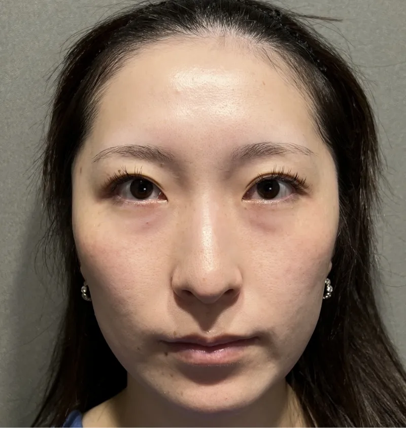 40代女性の目の下のふくらみ取り（脱脂）で劇的に若返った症例ビフォーアフター
