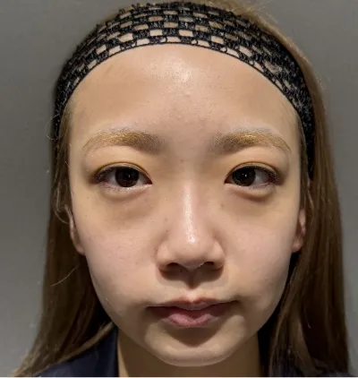 目の下のクマ取り（経結膜脱脂）の自然な変化がわかる症例写真ビフォーアフター