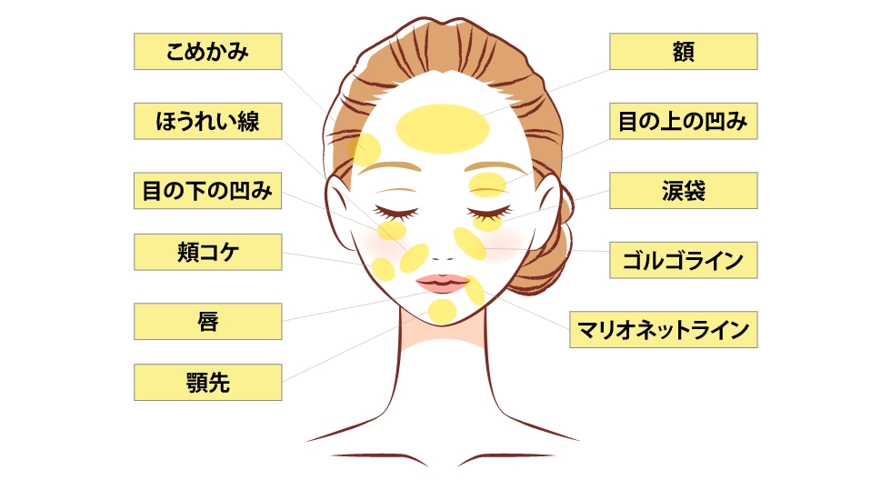 脂肪注入対象部位