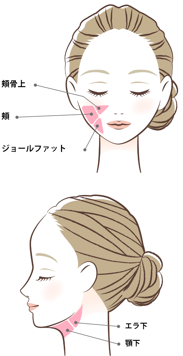 お顔の脂肪吸引と吸引方法